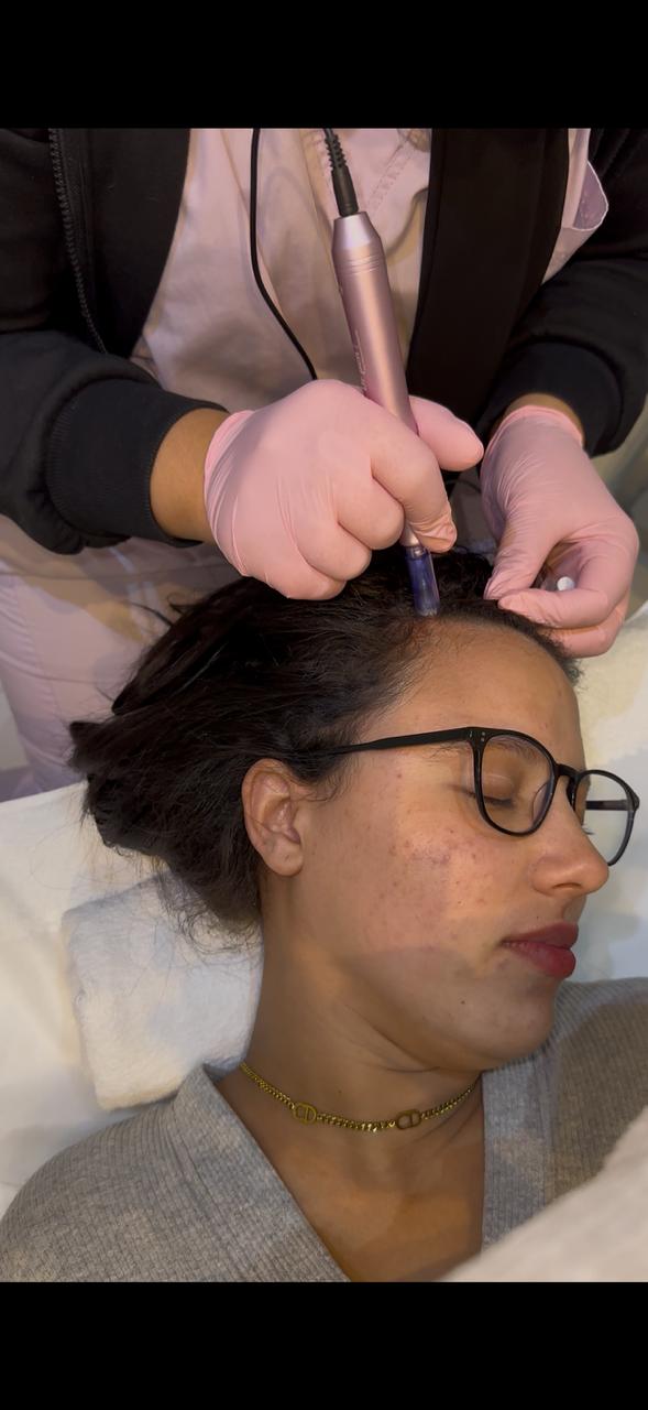 Mésothérapie capillaire